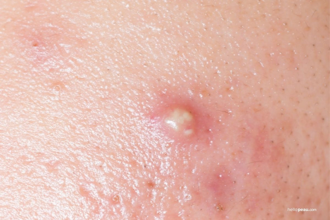 Can Pimple Patches Work for Cystic Acne?
