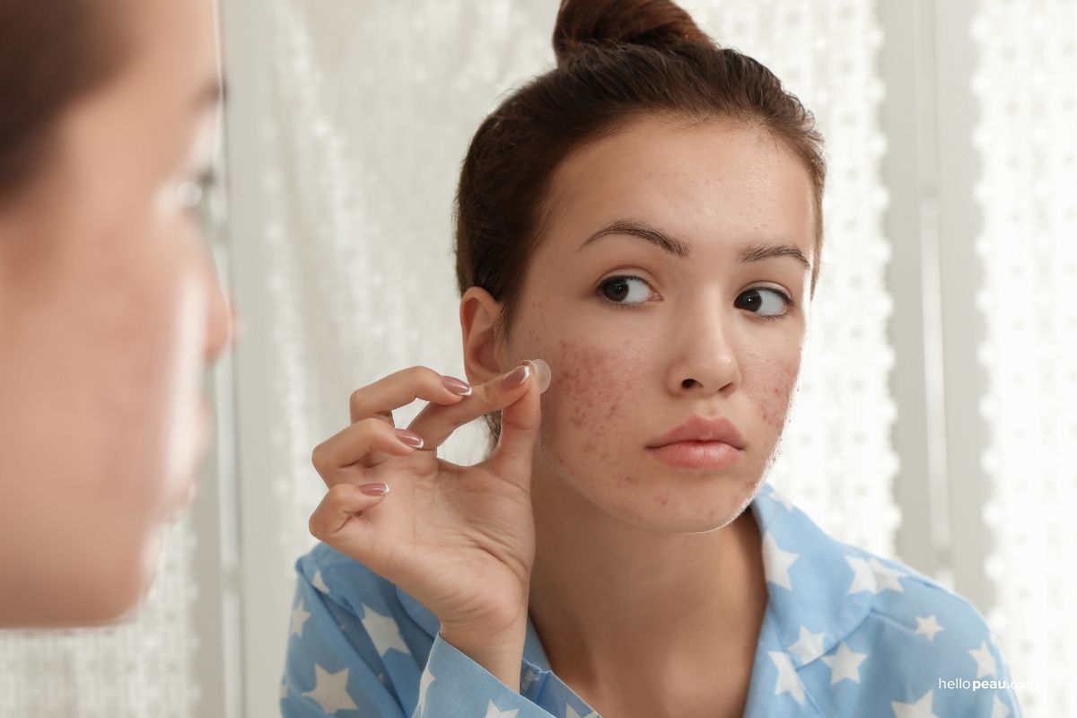 Hydrocolloid Patches for Acne: What They Are & How They Work