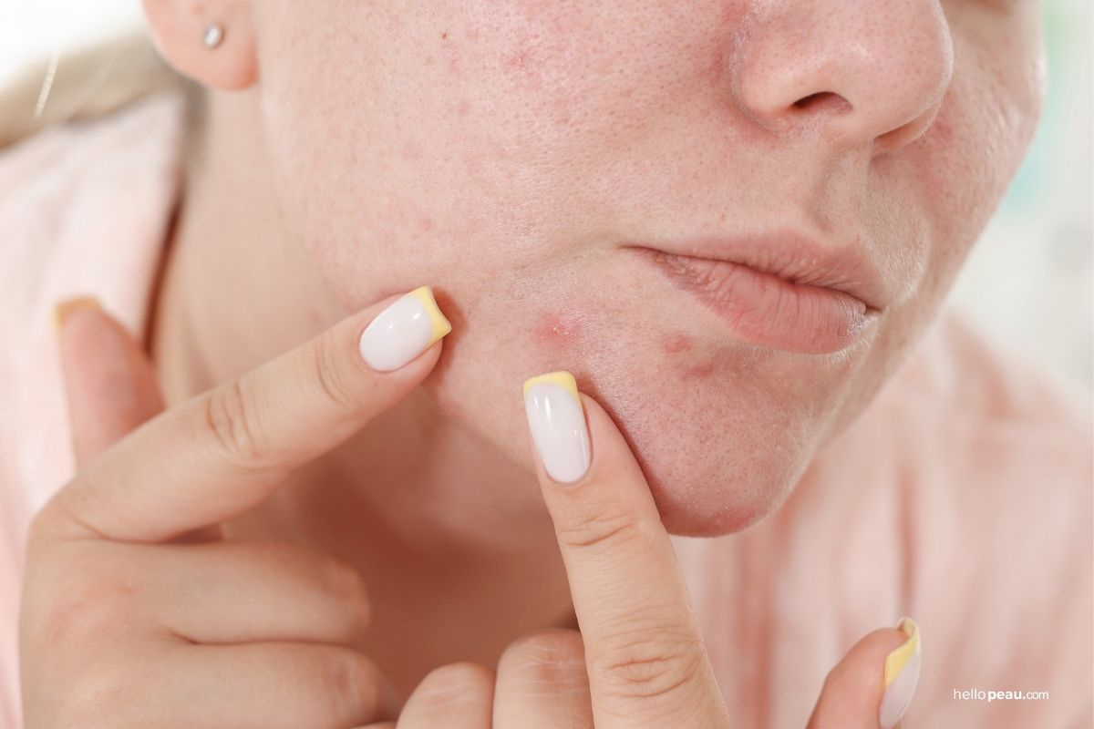 Why Your Skin Breaks Out More in Fall (And How to Stop It)
