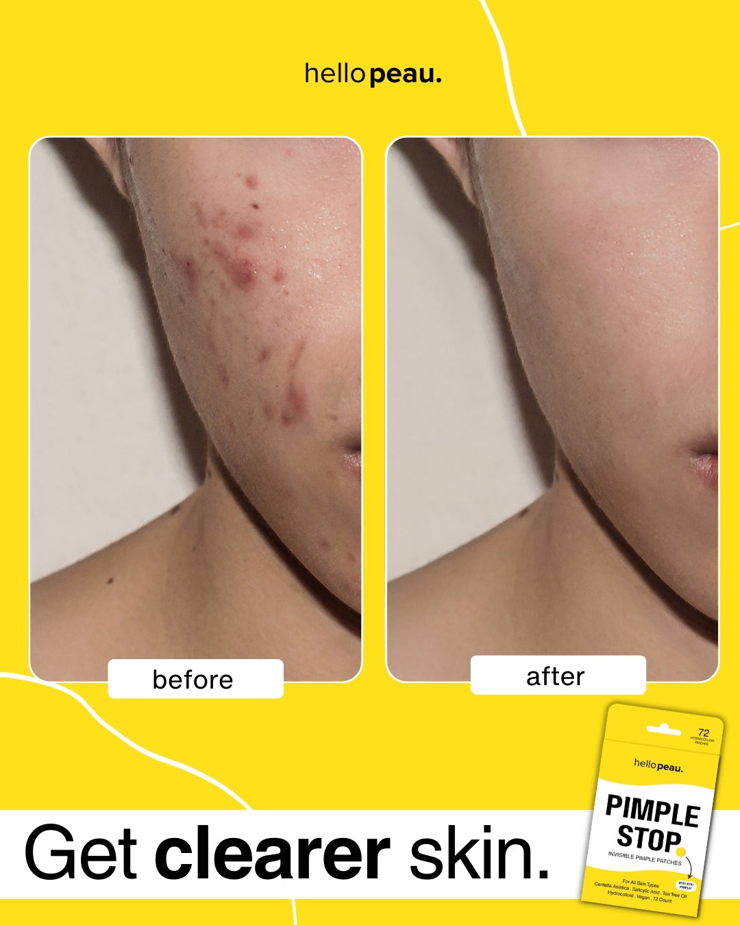Hello Peau Pimple Stop Hydrocolloid Vegan Invisible Pimple Patches - 72 count