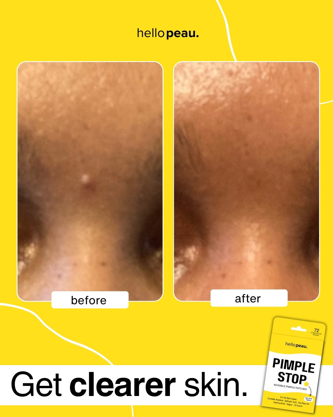 Hello Peau Pimple Stop Hydrocolloid Vegan Invisible Pimple Patches - 36 count - Hello Peau